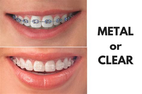 clear brackets or metal|replacement clear braces.